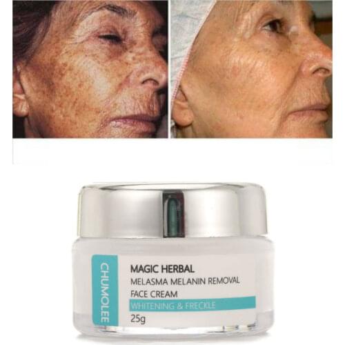 Chumolee Azelaic Acid 10% Whitening Cream Freckle Remove Melasma Acne Dark Pigment Spots Melanin Alpha Arbutin Face Cream