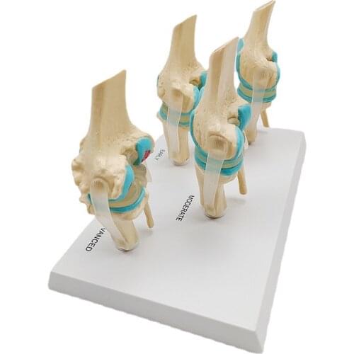 Human Anatomical 4-stage Knee Joint Skeleton Model Educational Medical Teaching Model Tool Drop Shipping