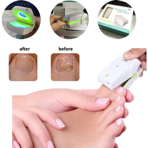 2020Home Use Cure Toe Nail Fungus Blue Light and Laser Light Therapy Device Onychomycosis Antifungal LLLT Physiotherapy