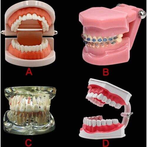 Dental Implant Disease Teeth Model With Restoration Bridge Tooth Dentist For Medical Science Dental Disease Teaching Study