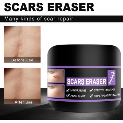 10g/20g/30g/50g Scar Cream Quick Absorption Multifunctional Skin Care Cold Scar Compress Gel for Adult