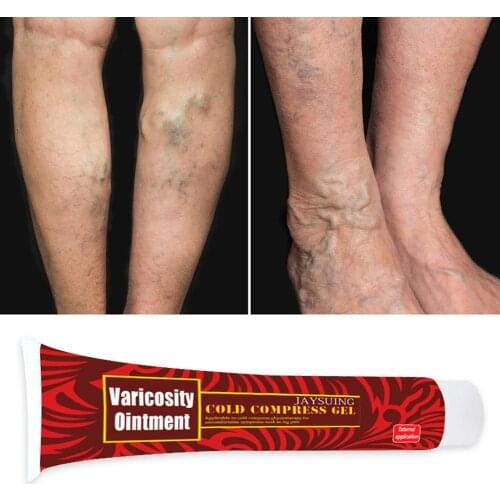 Varicose Veins Treatment Cream Pain Varicosity Angiitis Ointment Health Care Nodules Acidity Numbness Discomfort Symptoms Pain