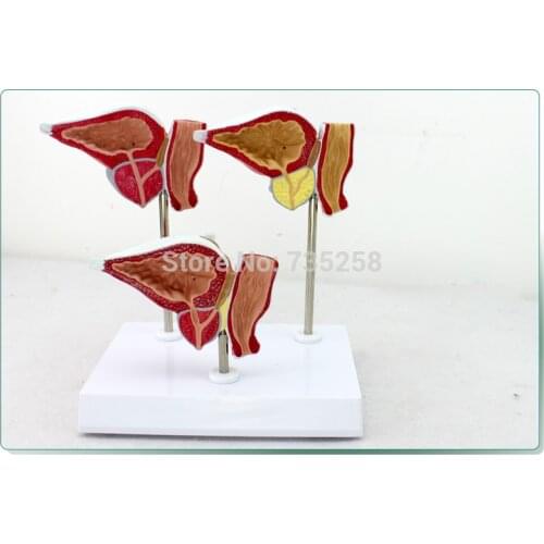 Normal And Pathological Changes Of Prostate Demonstration Model,Model of Prostatic Adenocarcinoma