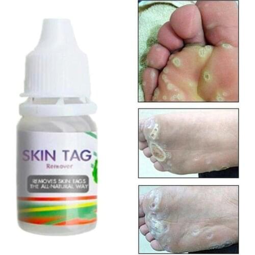 Chinese Medicinal Plaster Treatment for Corn Plantar Wart Removal Foot Care Ointment Wart Removal Ointment 10ML