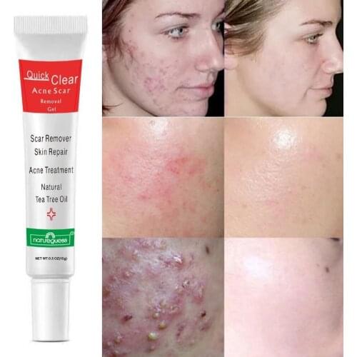 15g Acne Treatment Scars Remove Blackheads Shrink Pores Natural Tea Tree Oil Care Cream Skin Repair Gel