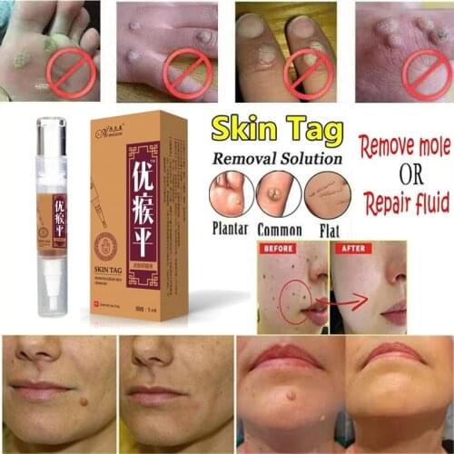 Skin Tag Remover Warts Treatment Against Mole & Genital Wart fast Removal Anti Foot Corn Removal Warts Papillomas Medical Oint