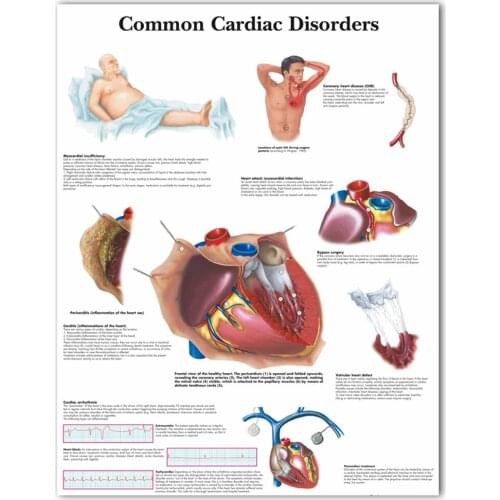 WANGART Anatomical Poster Common Cardiac Disorders Chart Canvas Print Wall Picture for Medical Education