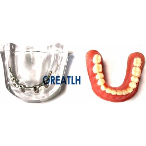 Overdenture Teeth implant repair model mandibular with Silver bar Dental Teaching For dental school education