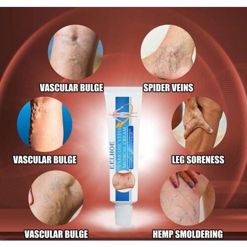 16g Varicosity Medical Varicose Veins Cream Treatment Massager Foot Phlebitis Vasculitis Foot Herbal Leg Product Anti R6E3