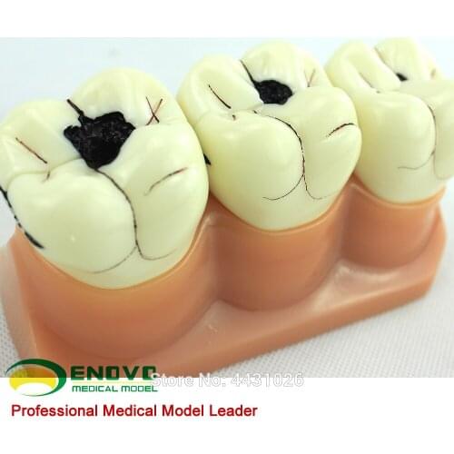 ENOVO Oral cavity dental caries breakdown model oral pathology dental caries model doctor-patient communication demonstration