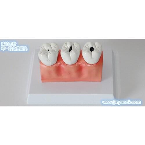 Oral pathology Dental caries tooth crypt gingiva model