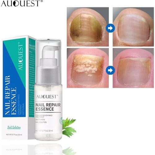 AUQUEST Nail Fungus Treatment Fungus Remedy Serum Essence Anti Paronychia Onychomycosis Nail Fungus Removal Gel Foot Care 20ml