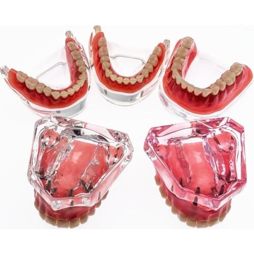 Overdenture implant teeth model Denture Teeth model with implant Dental ClinicTeaching Model