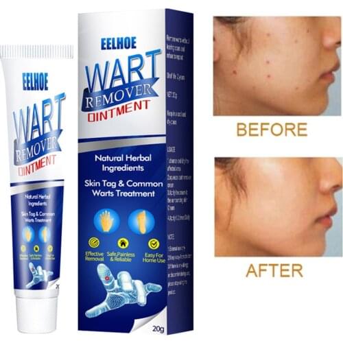 1pcs Skin Tag Remover Ointment Wart Moles Fast Remove Foot Corn Removal Warts Papillomas Rapidly Removes Moles Cream