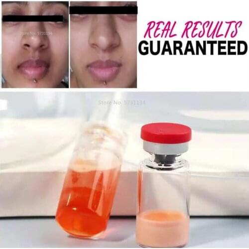 Remove Darkness Around Mouth and Chin Whitening Dark Spot Freckles More 100% Effective