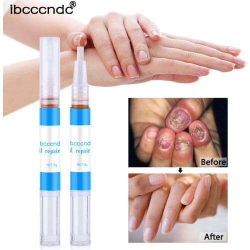 1 Piece Nail Repair Liquid Pen Fungal Nail Pen Effective Onychomycosis Paronychia Fungus Infection Repair Solution Gel Finger