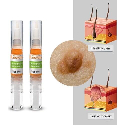 2/10pcs Skin Tag Remover 3-8 Weeks Medical Kill Remover Skin Tag Mole & Genital Wart Remover Foot Corn Removal 3ml