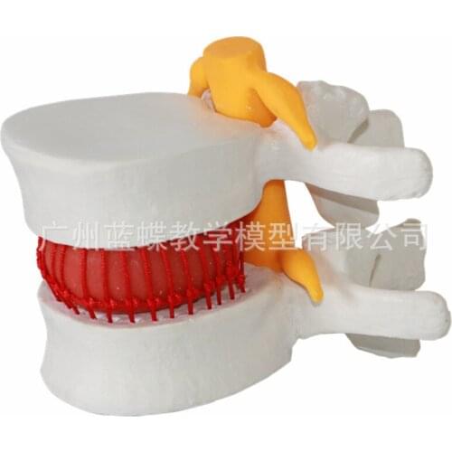 Human Lumbar Intervertebral Disc Compression Model Spine Vertebra Pathological Lateral Pressure Herniation Demonstration