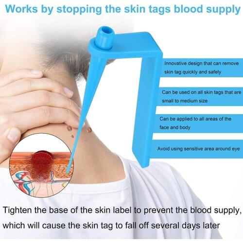 Skin tags remover remove warts body skin care tools wart treatment face Skin Tag Removal Tool Acne Remover