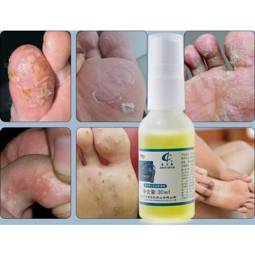 Foot Beriberi Cream Anti Fungal Plaster Itch Odor Peeling Blister Corn Chinese Herbal Antibacterial Ointment