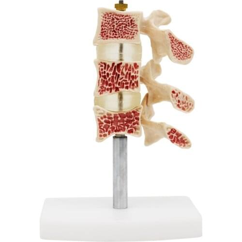 Osteoporotic lesion model Cervical spine planing model Osteoporotic joint model Skeleton model