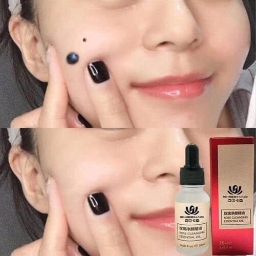 Mole & Skin Tag Removal Solution Painless Mole Skin Dark Spot Removal Face Wart Tag Freckle Removal Cream Oil Plaster
