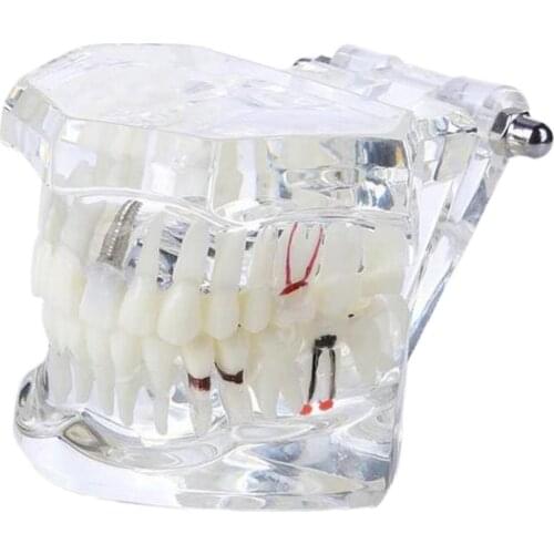 1pc Transparent Study Teeth Model with Nerve Repair Demonstration