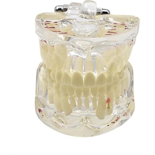 Dental Teeth Model Children Baby Pathology Teeth Model Disease Teeth Display Transparent Dentist Teaching Pathological Model
