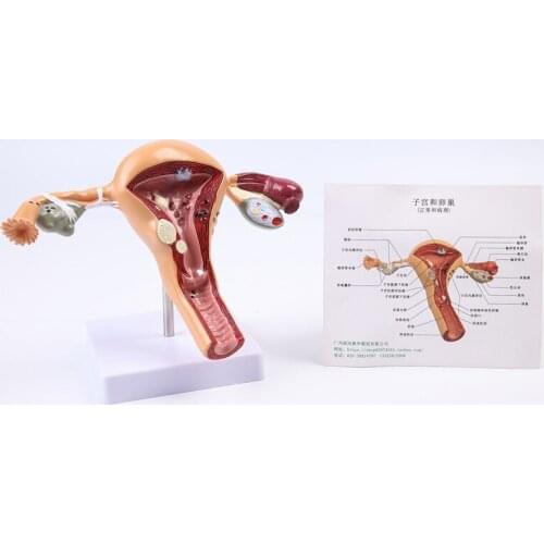Female reproductive uterus model diseased uterus model teaching aid gynecological anatomy ovary teaching model