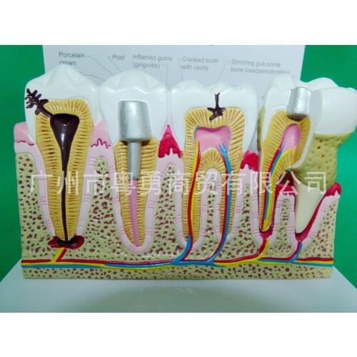 Desktop Teeth Common Pathologies Disease Model Tooth Decay Gingival Anatomy Dental Medical Teaching Model