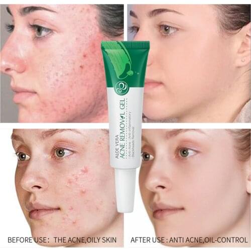 Effective Aloe Acne Removal Cream Acne Treatment Gel Fade Acne Spots Oil Control Shrink Pores Moisturizing Acne Scar Skin Care