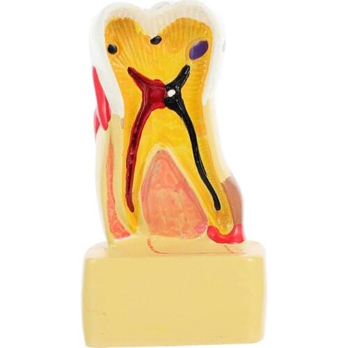 Tooth Anatomical Model Dental Caries Model Tooth Model Tooth Decay Disease Comprehensive Pathological Model Educational Model