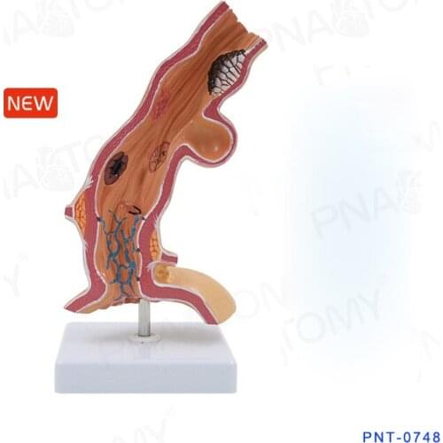 ISO esophageal pathoanatomical model，Anatomical model of esophagus，Esophageal pathological model