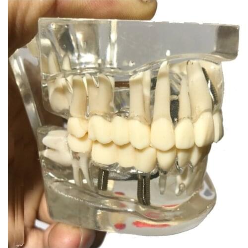 Crystal Dental Disease Teeth Model With Restoration Bridge Tooth For Medical Science Dental Disease Teaching Model
