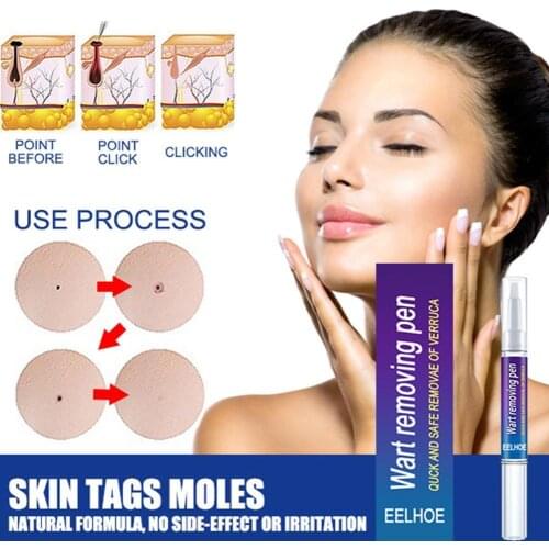 100% Quality Skin Tag Genital Wart Remover Pen Warts Liquid From Skin Tag Removing Against Moles Remover Anti Foot Callus Produc