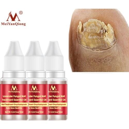 3pcs MeiYanQiong Fungal Nail Treatment Serum Anti-Fungal Nail Infection Onychomycosis Paronychia Toe Fungus Repair Nail Care