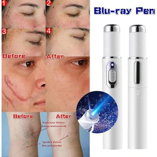 Acne Laser Pen KD-7910 Portable Wrinkle Removal Machine Blue Light Therapy Massage Relax Soft Scar Dark Circles Remover Device