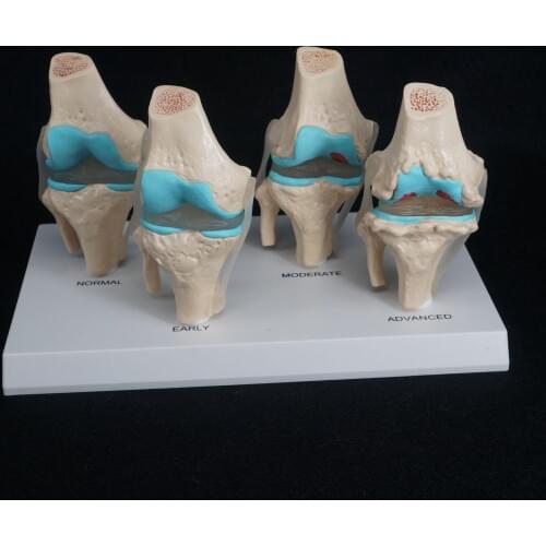 Anatomical Human Degenerative Knee Joint Disease Model Medical Skeleton Anatomy Learning Resources