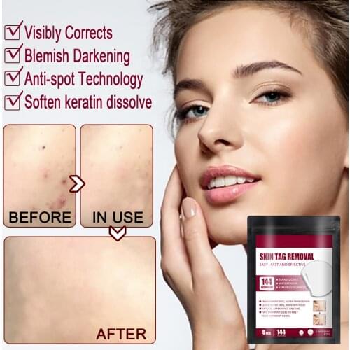 Instant Spot Removal Gel Skin Tag Removal Patches Wart Removal Body Warts Treatment Foot Care Cream Skin Tag Remover SK88