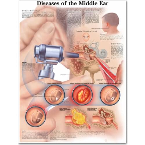 Diseases of the Middle Ear Chart Poster Print Canvas Painting Wall Pictures for Medical Education Doctors Office Classroom