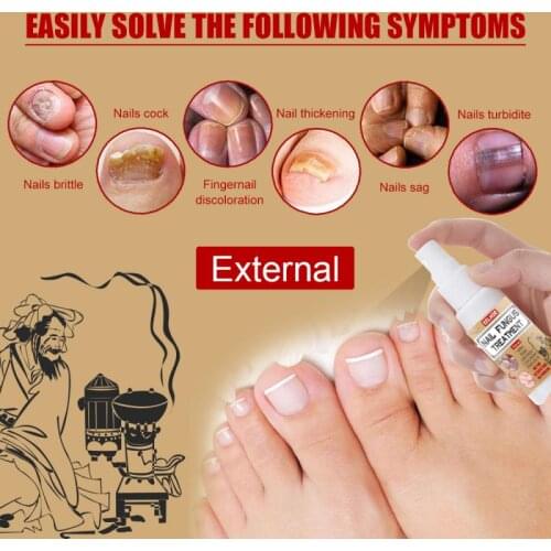 EELHOE Nail Repair Spray Serum Fungal Nail Treatment Remove Onychomycosis Toe Nourishing Brighten Hand Foot Skin Care TSLM2