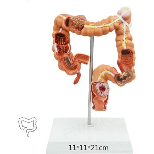 Colon pathological model Large intestine model medical anatomy teaching in gastroenterology department of anorectal Department