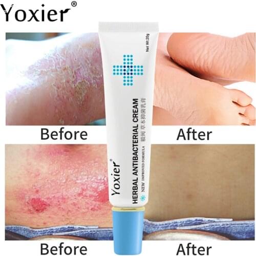 Yoxier Herbal Antibacterial Cream Psoriasis Cream Anti-itch Relief Eczema Skin Rash Urticaria Desquamation Treatment