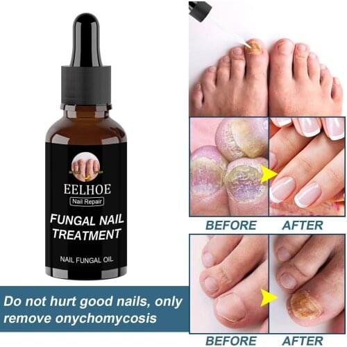 Fungal Nail Pen Effective Onychomycosis Paronychia Infection Solution Fungus Essence Toenail Treatment Nutrient Gel Repair O5X7