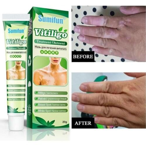 20G Skin Spot Care and Health Cream Effectively Relieve Dermatitis and Ringworm Ointment Prevent Skin Infections Paste