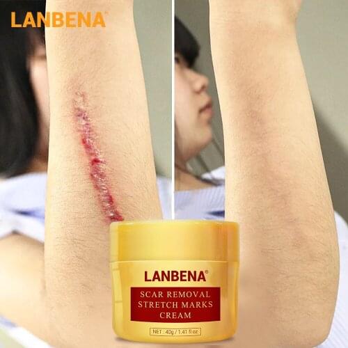LANBENA Scar Removal Cream Acne Treatment Repairing Blackhead Shrink Pores Whitening Moisturizing Skin Care Creme 40g