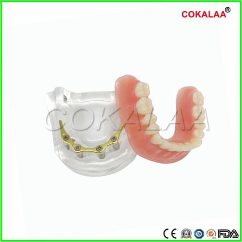 Good quality Preparation model dental implant model dentures teeth model for dentists learning
