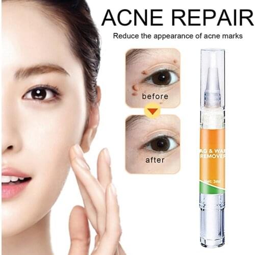 Genital Wart Treatment Papillomas Removal of Warts Liquid From Skin Tags Removing Against Moles Remover Anti Verruca Remed