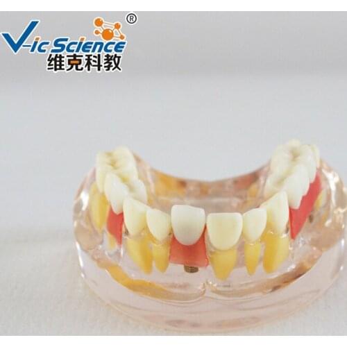 Implant Demonstration Model/Implant Demonstration/Implant Model