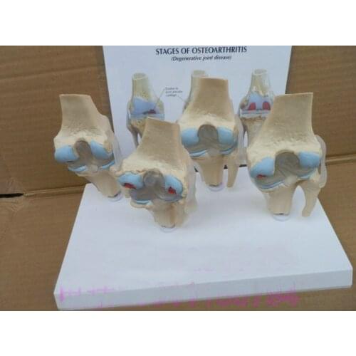 Pathology Knee Joint model abnormal state Knee Joint Lesions model skeleton model degenerative joint disease